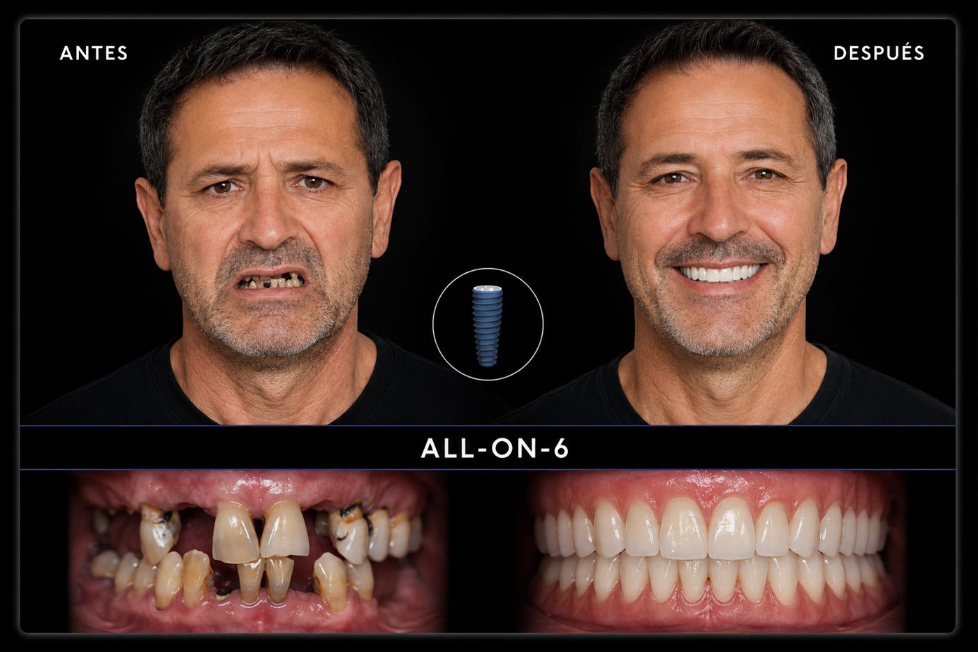 Resultado All-on-6 — antes y después